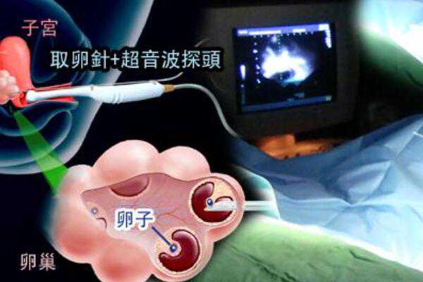 无锡湘雅二医院试管婴儿成功率高吗,无锡试管移植成功率高吗？